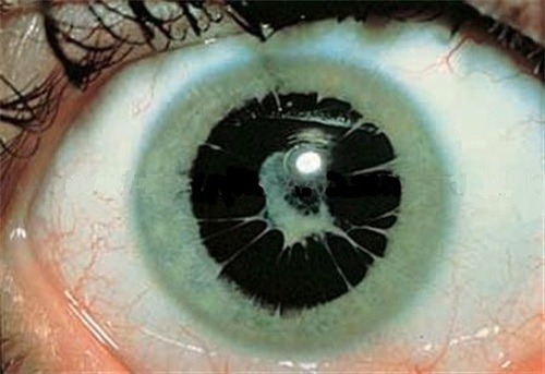 sixpenceee:  Persistent pupillary membranes are strands of tissue in the eye. They