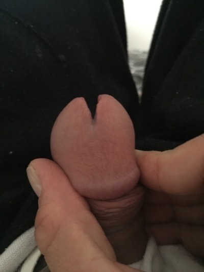 My split penis