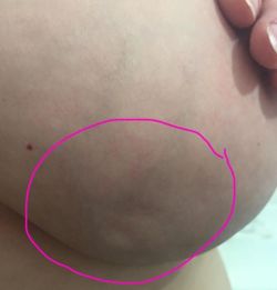 genderphobia: rosezeee:  micdotcom:  Don’t scroll past this. Kylie Armstrong was diagnosed with breast cancer and these small dimples were the only signs. She posted the image on Facebook so everyone knows that “that breast cancer is not always