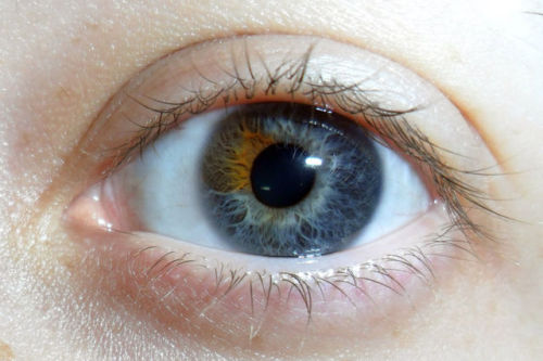 In sectoral heterochromia one part of the eye is different from it’s remainder. Heterochromia, in ge