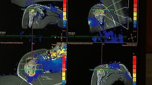 Doctors in London have started trials of an experimental therapy that might one day become a new way to destroy cancers. By using powerful ultrasound waves, they can burn away tissues in the body - and one day, tumours - without leading to side-effects