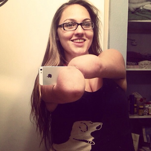 ilikeamputees: onelegvin: A rare but beautiful congenital DBE. Whats amazing to me is that she is al