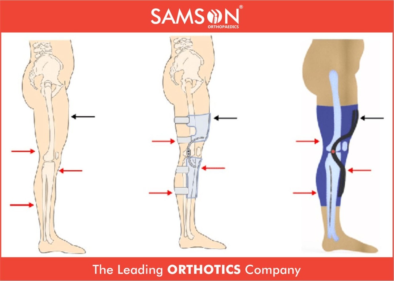 samsonorthopedicsindia On Tumblr samsonorthopedicsindia-on-tumblr