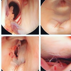 doctordconline:  Endoscopic third ventriculostomy