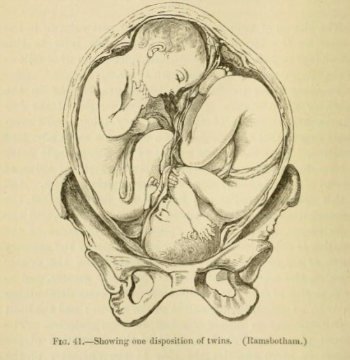 nemfrog: Fig. 41. Twins. A System of Obstetric Medicine and Surgery. 1884.