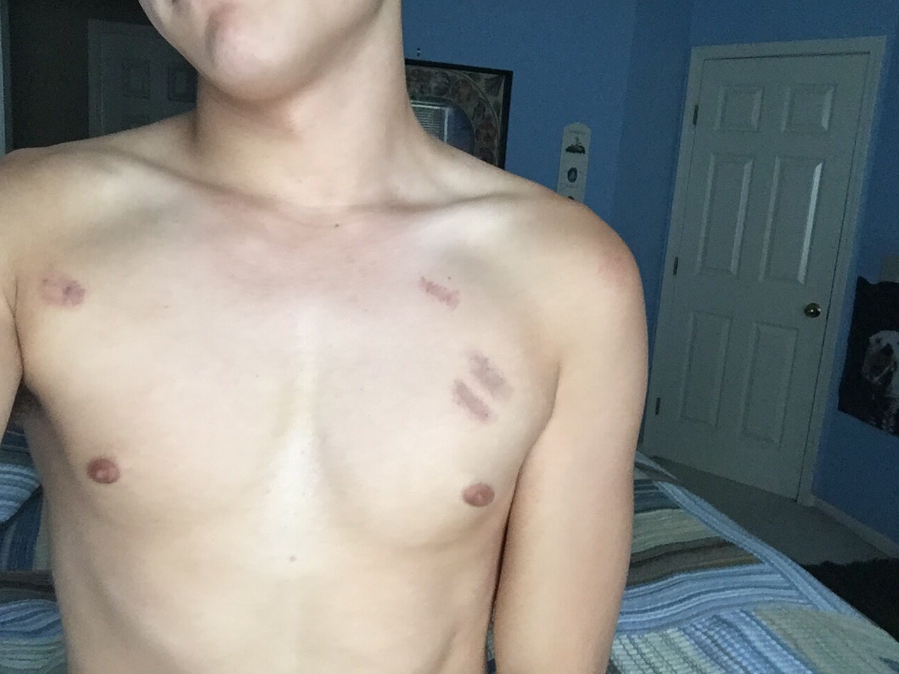 gayfrustrationblog:  Hickeys