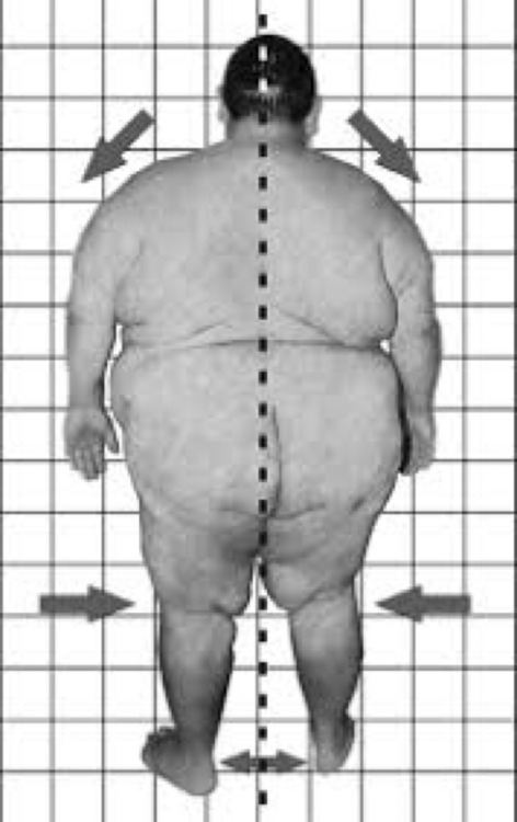 thehistoryofheaviness:Vintage medical diagram illustrating the effects of obesity on posture &hellip