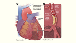 kqedscience:  New Imaging Method May Help Detect Heart Attack Risk in the Future&ldquo;A non-invasive imaging method could help identify and localize artery-clogging plaques that are likely to cause a heart attack. If future studies confirm the initial