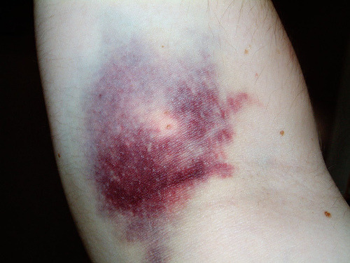 the colour of veins and bruises. porn pictures