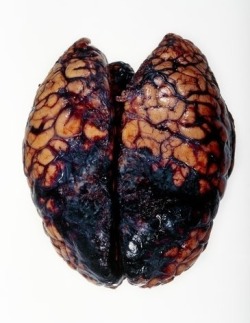 fuckyeahforensics:  Brain hemorrhage, post-mortem