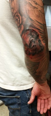 Got my elbow filled, need to post it when it’s healed