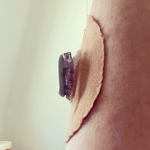 When you add extra adhesives to your #Dexcom do you find that it pops out the cut out hole instead o