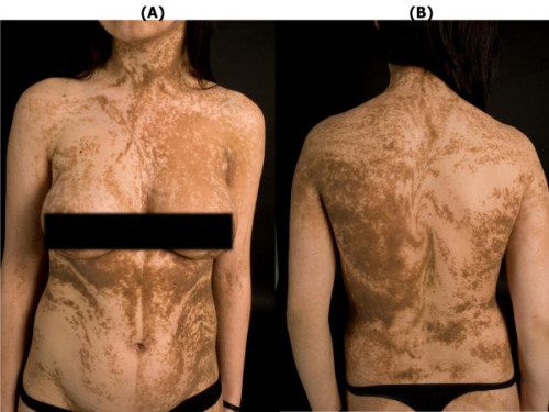 17-year old woman with an extensive, systemic epidermal nevus following the lines of Blaschko. [sour