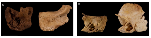 theolduvaigorge: Alterations of skull bones found in anencephalic skeletons from an identified 