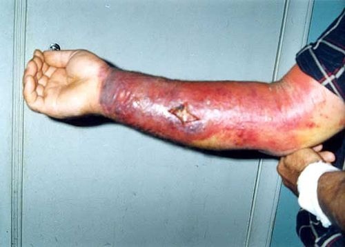 llady-cadaver: The skin reacting to contact with the bacterium Bacillus anthracis. More commonly kno