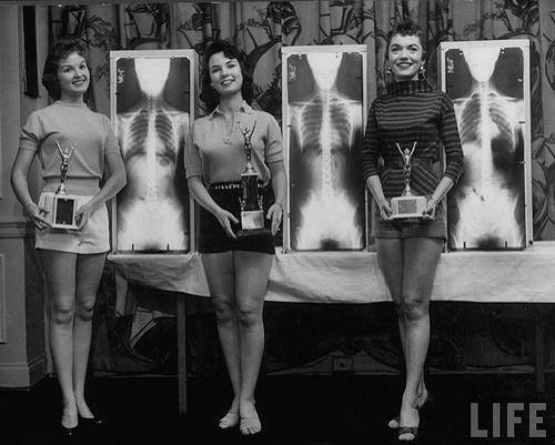 radiopaedia:  Winners of the Miss Perfect Posture contest at the national chiropractors