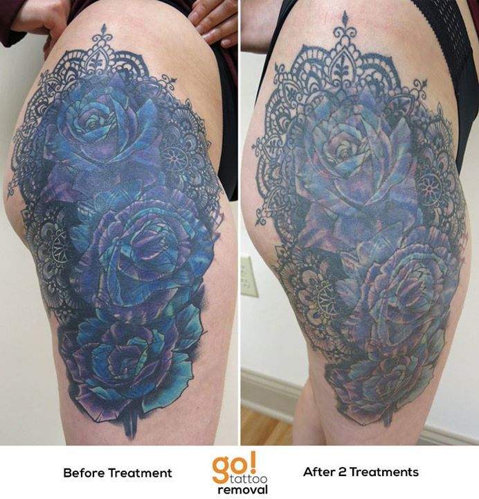 GO Tattoo Removal on Twitter Part 3 of 3 This huge project was brought  to us by a collector who had started tattoo removal elsewhere but sadly  they are no longer in