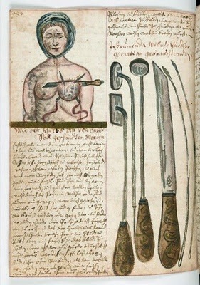 circa 1675 Illustration of a woman having a breast operation, accompanied by a close