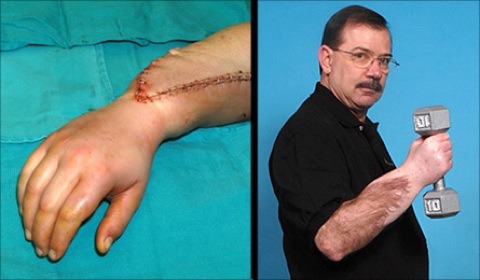 tehblurredline:  Watching an interesting doco on hand transplants in the U.K and