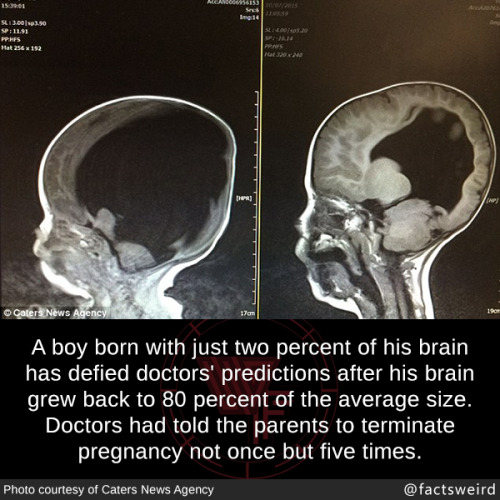 mccarthyites: mindblowingfactz: A boy born with just two percent of his brain has defied doctors’ pr