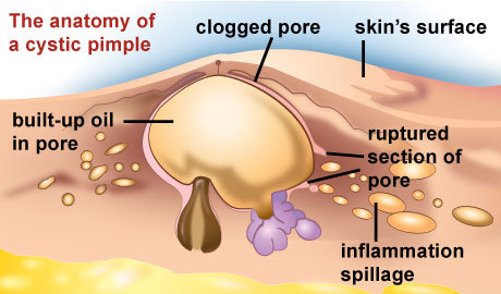 Cystic Acne: Symptom, Prevention and TreatmentAcne is characterized as the swelling