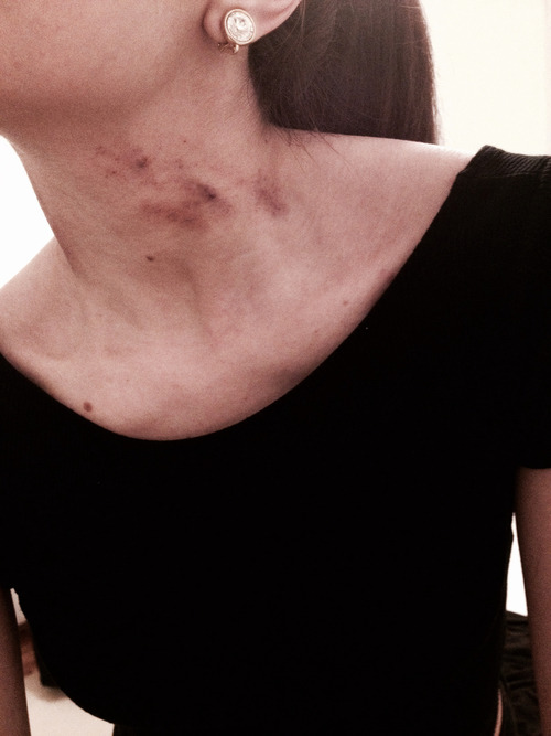 contusions