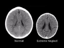 amorformusic:  auntrubyk:  poopy-da-third:  sixpenceee:  Chilling Brain Scans Show the Impact of a Mother’s Love on a Child’s Brain Size A shocking comparison of brain scans from two three-year-old children reveals new evidence of the remarkable impact