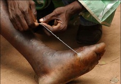 Guinea worm disease, aka Dracunculiasis, is one of those horrible stories that people tell you about traveling to third world nations. Usually the baby worm is swallowed with dirty water, then it sits in the digestive tract for a year. It then migrates