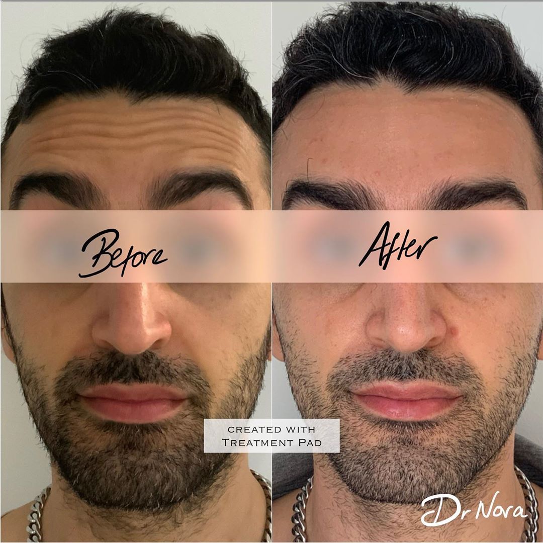 Anti-wrinkle treatment of the forehead ðŸ˜²Anti-wrinkle therapy is a quick and easy way to reduce the appearance of strong and deep lines. Treatment time is 15 minutes, optimal results are seen at 2 weeks and lasts up to 3-5 months.
If you have any...