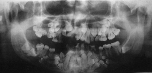 Supernumerary teeth brought on by cleidocranial dysplasia.