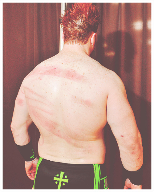 w4de-barrett:  Sheamus getting treated for his welts.  OUCH!!!