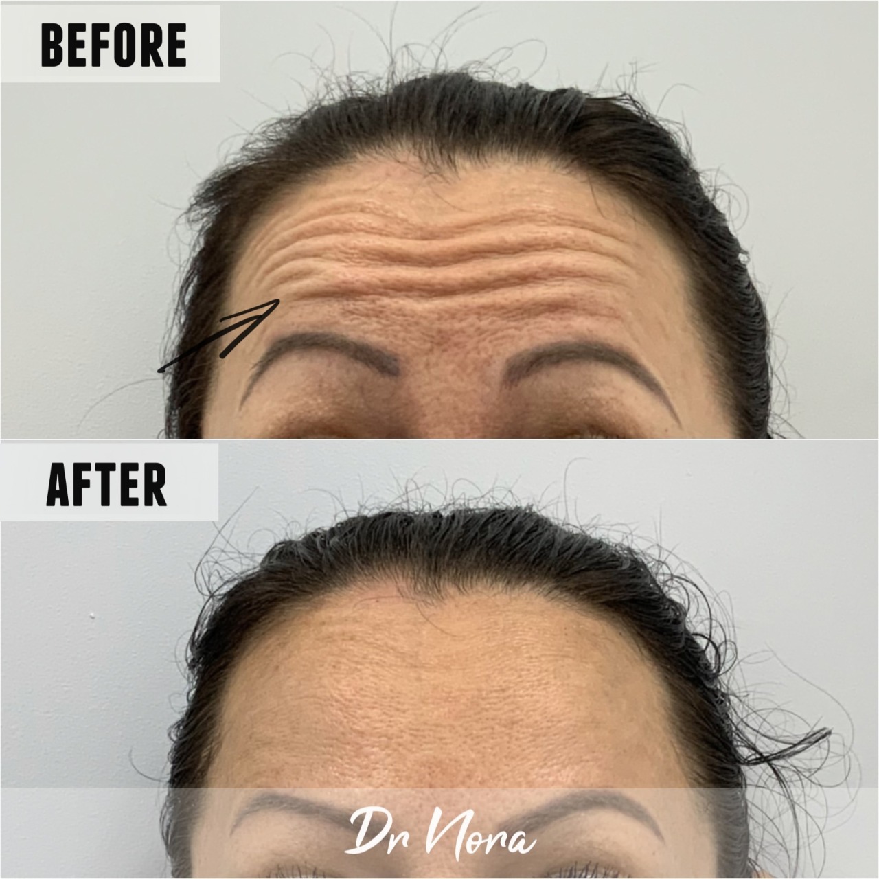 Anti-wrinkle treatment of the forehead ðŸ˜²Anti-wrinkle therapy is a way to reduce the appearance of strong and deep lines. Treatment time is 15 minutes, optimal results are seen at 2 weeks and lasts up to 3-5 months.
If you have any questions or would...
