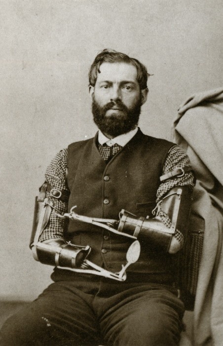 Samuel Decker, a Civil War veteran who with the help of his wife designed and built his own prosthet