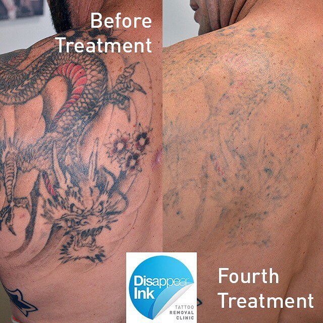 Sydney Laser Tattoo Removal — Our client asked us to remove his Dragon  tattoo....