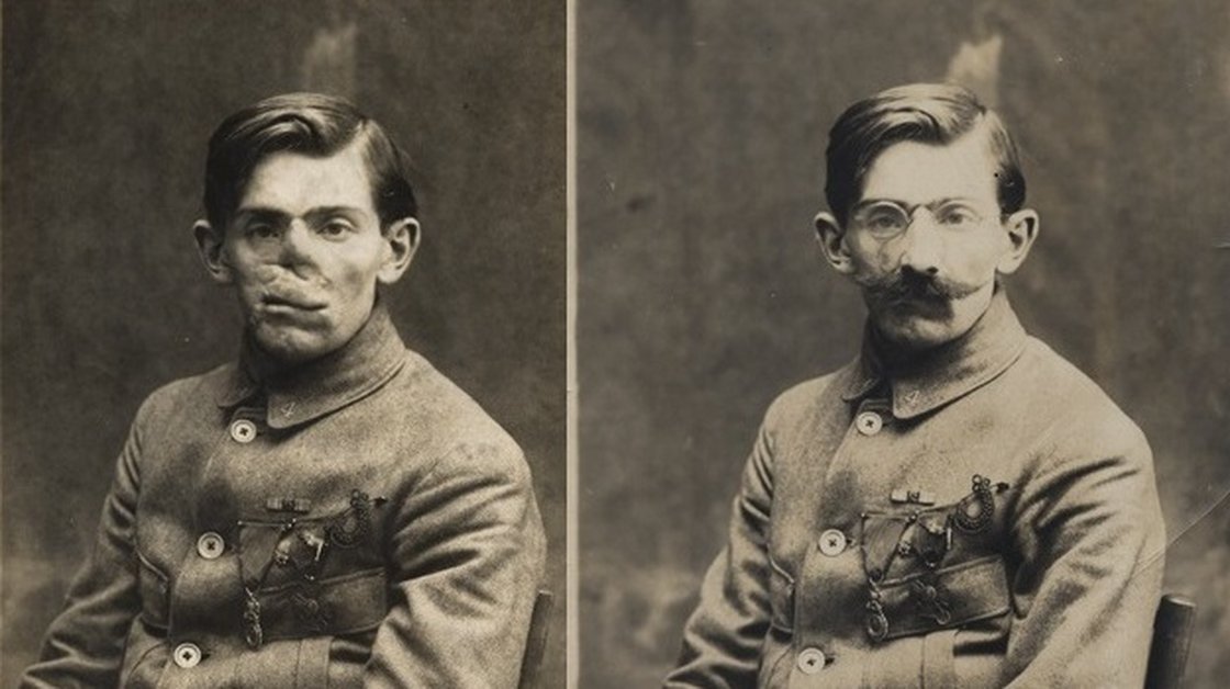 npr:
“ World War I left many soldiers with disfiguring scars. So American artist Anna Coleman Ladd set up her own studio in Paris and set to work sculpting new faces for those who had lost a piece of theirs in trench warfare.
Ladd started by getting...