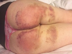 Nefariouskinks: Purrr-Maid:   Another Bruised Booty Pic. And To Think I Thought It