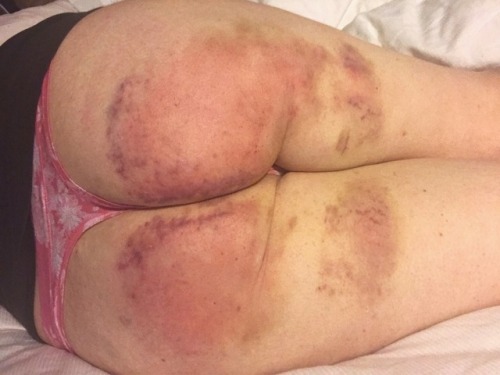 Porn photo nefariouskinks: purrr-maid:   Another bruised