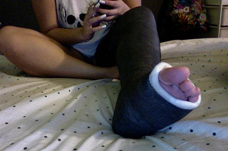 alexia17fan: long black leg cast and white painted nails!! in a cast for 8 weeks….so Humbling