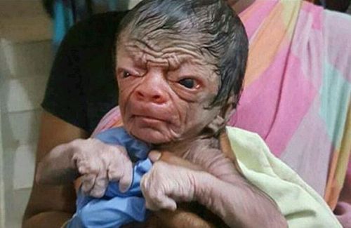 Progeria also known as Hutchinson-gilford progeria syndrome is a genetic disorder that causes a child to age rapidly. It is caused by mutation of a gene known as lamin A(LMNA) and is not hereditary.
The child usually does not grow or gain weight...