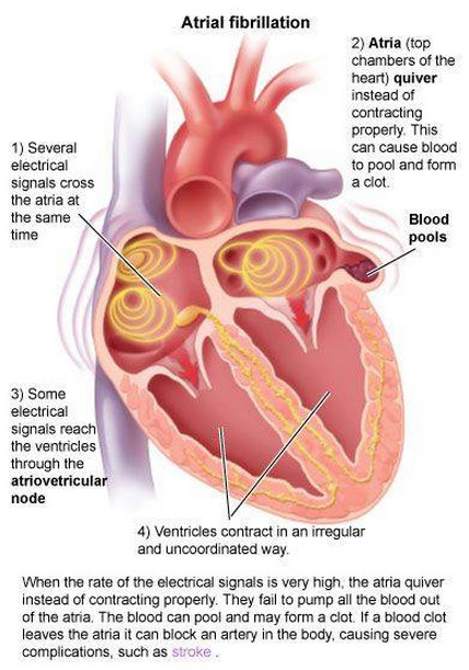 studentparamedics: &ldquo;Atrial Fibrillation is the most common cardiac arrhythmia, which occur