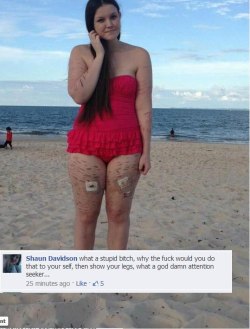 shadowspenguins:   cooknut:    The girl wrote this on Facebook: ”I went to the beach the other day, for the first time since I was a child, I didn’t wear shorts or anything to cover up, this is a massive deal for me, I hate my body even without the