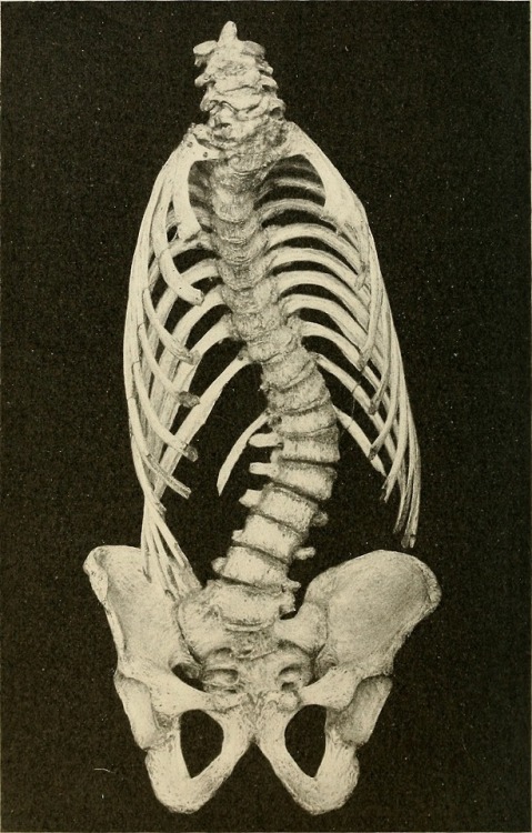 Lateral curvature of the spine and round shoulders, 1907