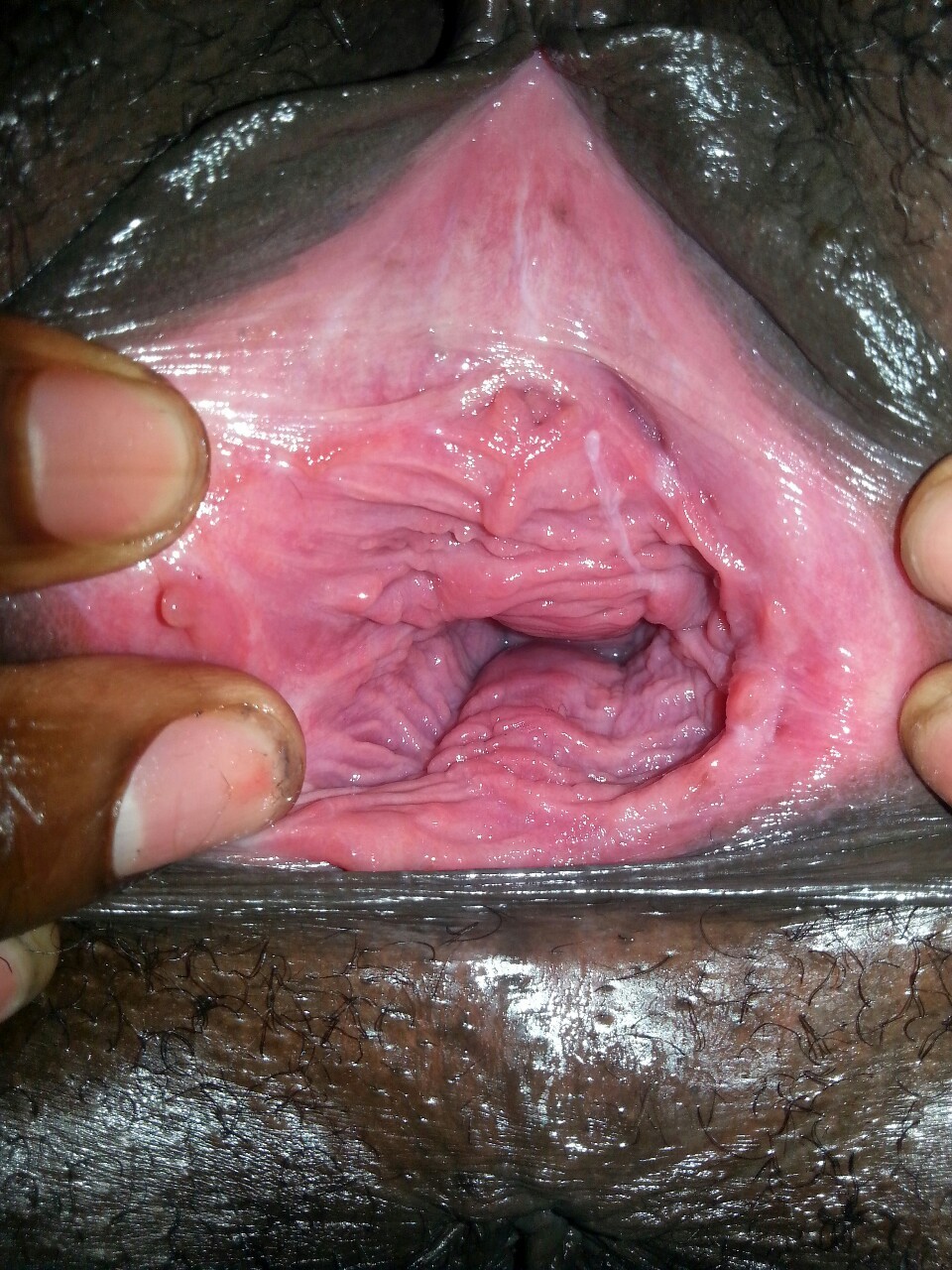 Vaginal Abnormalities