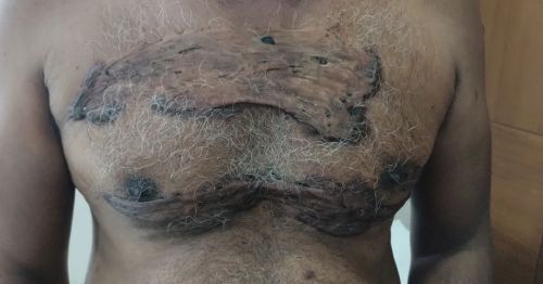 KELOID #surgery #surgeon #medicine https://www.instagram.com/p/CbnicSPBakO/?utm_medium=tumblr