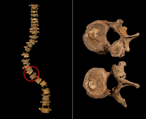 thebritishnobility:Richard III : The twisted bones that reveal a king When Richard was killed at t