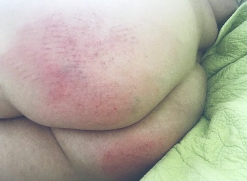 spankme-callmebaby:  Plugged and bruisedSpoil adult photos