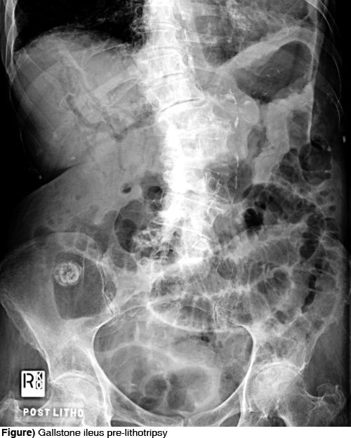 cluelessmedic: Gallstone Ileus stone erodes through the gallbladder in to the duodenum formation of 