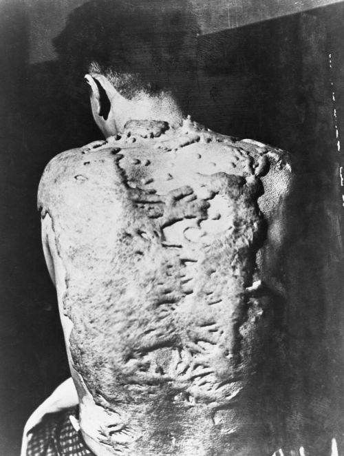 1st photo: Keloids cover the back of a survivor of the Nagasaki atomic bomb. Keloids are dense, fibr