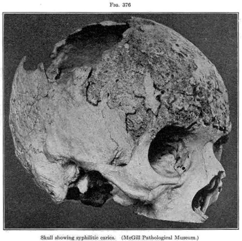 carriebou: Skull of a patient infected with syphilis - exact date unknown