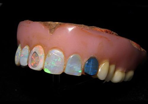 andrusmagnus:Opal DenturesOwned by British Rugby Player Harold Hodges